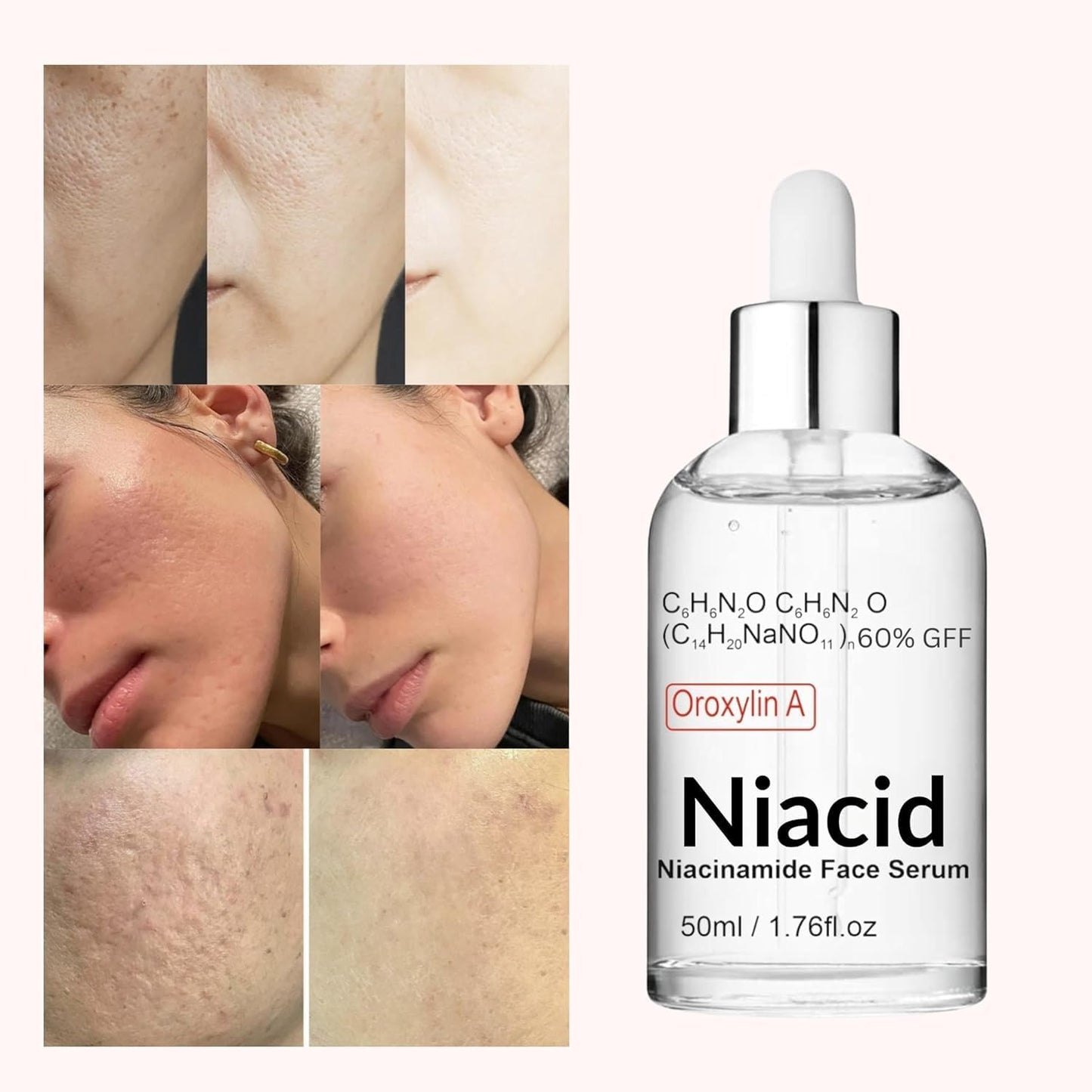 Niacid Face Serum for Open Pores & Dark Acne – 50 ml