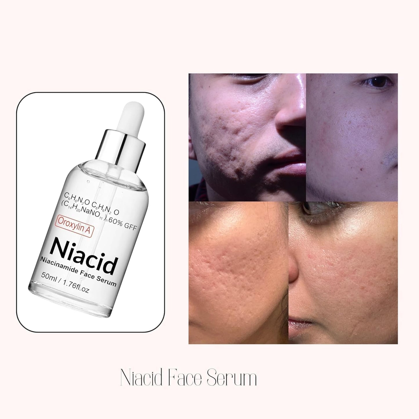 Niacid Face Serum for Open Pores & Dark Acne – 50 ml