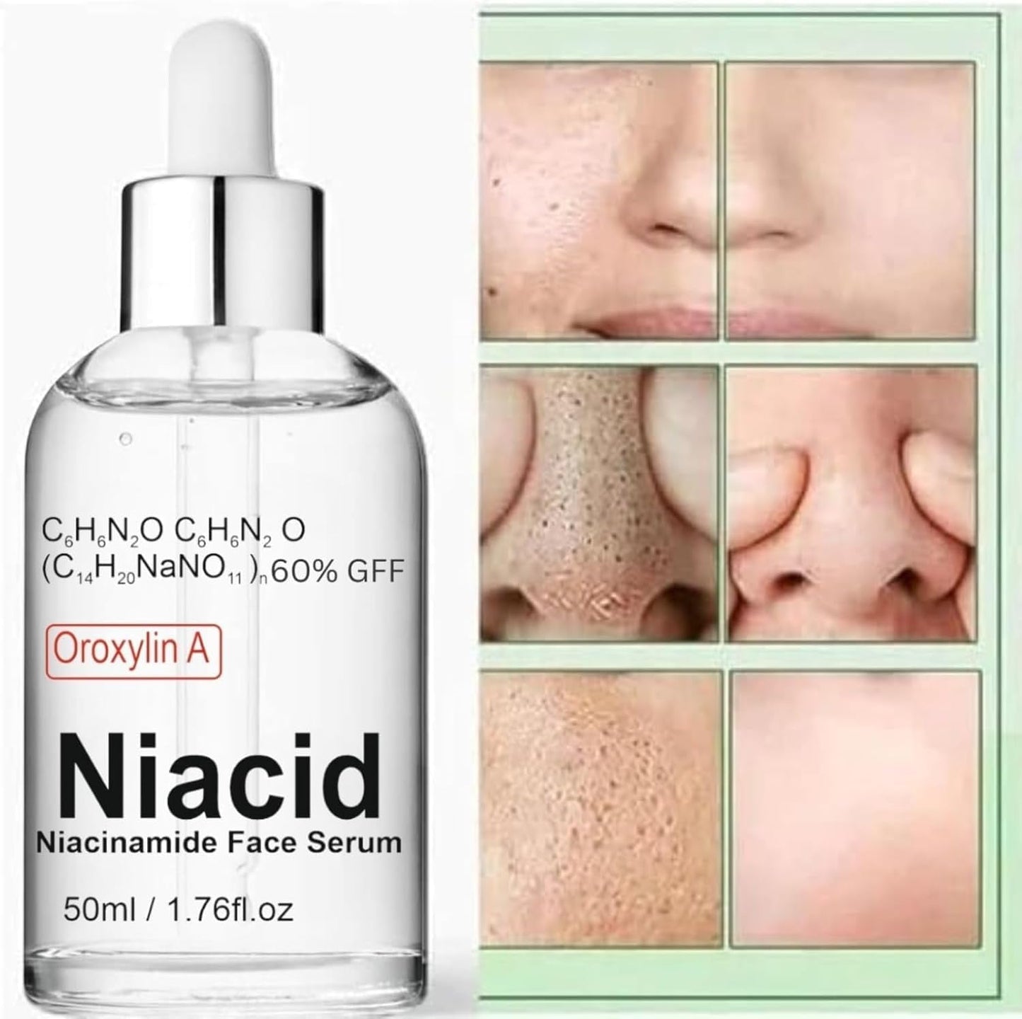 Niacid Face Serum for Open Pores & Dark Acne – 50 ml